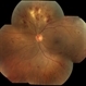 Diabetic Retinopahty