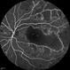 Idiopathic Occlusive Retinal Vasculitis (Late Stage) Idiopathic Occlusive Retinal Vasculitis (Late Stage)