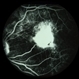 Toxocara Granuloma Toxocara Granuloma
