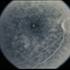 Macular Hole Evolving / Lamellar Hole Macular Hole Evolving / Lamellar Hole