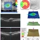BRVO With Decreased Vision from Ruptured Aneurysm in Area of Collateral Vessels BRVO With Decreased Vision from Ruptured Aneurysm in Area of Collateral Vessels