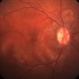 Preeclampsia in a 30-Year-Old  - Color Fundus Photograph - RE Preeclampsia in a 30-Year-Old  - Color Fundus Photograph - RE