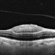 OCT of a sub-internal limiting membrane hemorrhage in Valsalva retinopathy OCT of a sub-internal limiting membrane hemorrhage in Valsalva retinopathy