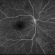 Retinal Vasculitis Retinal Vasculitis