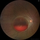 Valsalva Retinopathy