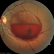 Subhyaloid Hemorrhage after Pulsed ND:YAG laser Subhyaloid Hemorrhage after Pulsed ND:YAG laser