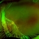 Retinal Detachment with Giant Retinal Tear Retinal Detachment with Giant Retinal Tear