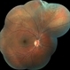 Hyaloid Artery Hyaloid Artery