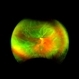 Rhegmatogenous Retinal Detachment in Myopic Patient