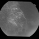 Adult Coats' Disease