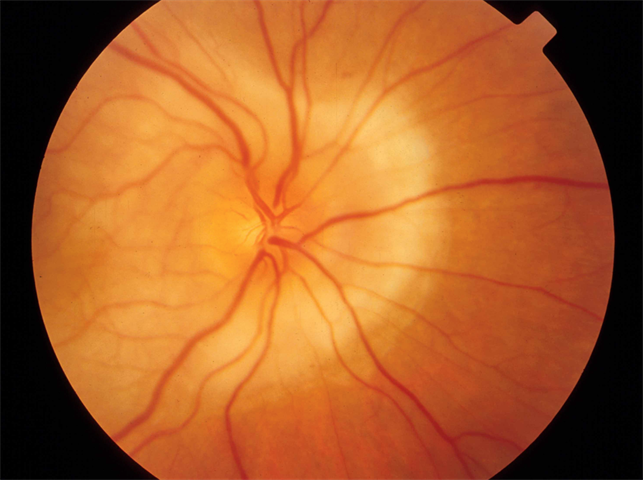 Vogt-Koyanagi-Harada Disease - Retina Image Bank