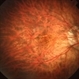 High Myopia High Myopia