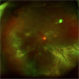 Retinal Detachment Retinal Detachment