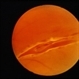 Traumatic Retinal Detachment