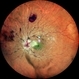 ANAEMIC RETINOPATHY