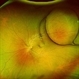 Posterior Dislocated Intraocular Lens Posterior Dislocated Intraocular Lens