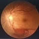 Sub hyaloid haemorrhage 10 minutes after LASER hyaloidotomy