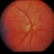 Sturge-Weber / Choroidal Hemangioma Sturge-Weber / Choroidal Hemangioma