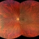 Tigroid Fundus Tigroid Fundus