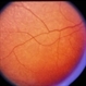 Leber's Congenital Amaurosis