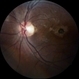 Traumatice Macular Hole Traumatice Macular Hole