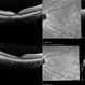 Paracentral Acute Middle Maculopathy (PAMM) Paracentral Acute Middle Maculopathy (PAMM)