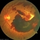 Subhyaloid Hemorrhage With Flat Neovascular Vessels