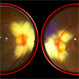 Myelinated Retinal Nerve Fiber Layer
