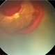 Aggressive Posterior Retinopathy of Prematurity