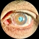 Wrinkled Anterior Capsule 10X zoom