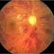 Central Retinal Vein Occlusion Central Retinal Vein Occlusion
