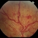 Venous Beading