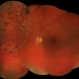 Sectoral Retinitis Pigmentosa