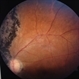 Self-Applied Retinal Detachment Self-Applied Retinal Detachment