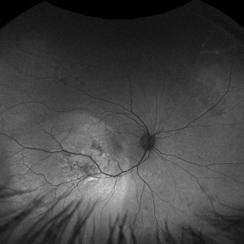 Choroidal Metastasis - Retina Image Bank