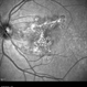 Macula Serpiginous Choroidopathy Macula Serpiginous Choroidopathy