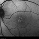 Retinal Dystrophy of 24-Year-Old Male/ AF OS Retinal Dystrophy of 24-Year-Old Male/ AF OS