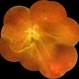 Diabetic Macular TRD Diabetic Macular TRD