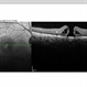Full Thickness Macular Hole OCT Full Thickness Macular Hole OCT