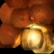 Dislocated IOL in Vitreous in a Eye With Choroidal Coloboma Dislocated IOL in Vitreous in a Eye With Choroidal Coloboma