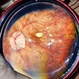 Pathological Myopia Pathological Myopia