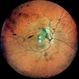 Old Supero-Temporal Branch Retinal Vein Occlusion with Macular Hole Old Supero-Temporal Branch Retinal Vein Occlusion with Macular Hole