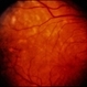 Metastatic Breast Cancer
