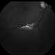 Choriodal Rupture - 003 - 6 Month Follow Up Choriodal Rupture - 003 - 6 Month Follow Up