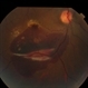 Choriodal Rupture - AW 001 - Initial Presentation Choriodal Rupture - AW 001 - Initial Presentation