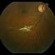 Choriodal Rupture - AW 002 - 6 Month F/U Choriodal Rupture - AW 002 - 6 Month F/U