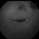 Choriodal Rupture  004 - Fundus Autoflurescence - 6 Month Follow Up Choriodal Rupture  004 - Fundus Autoflurescence - 6 Month Follow Up