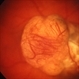 Choroidal melanoma color Choroidal melanoma color