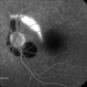 Choroidal rupture and peripapillary hemorrhage - FA Choroidal rupture and peripapillary hemorrhage - FA