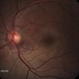 Choroidal rupture and peripapillary hemorrhage - Fundus image Choroidal rupture and peripapillary hemorrhage - Fundus image